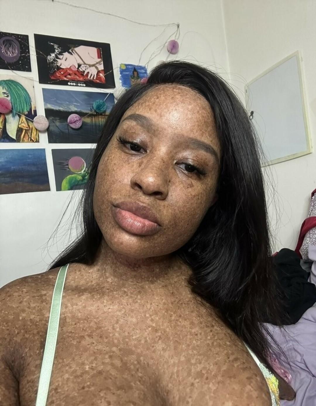 freckledn-1